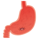 ピロリ菌と胃潰瘍