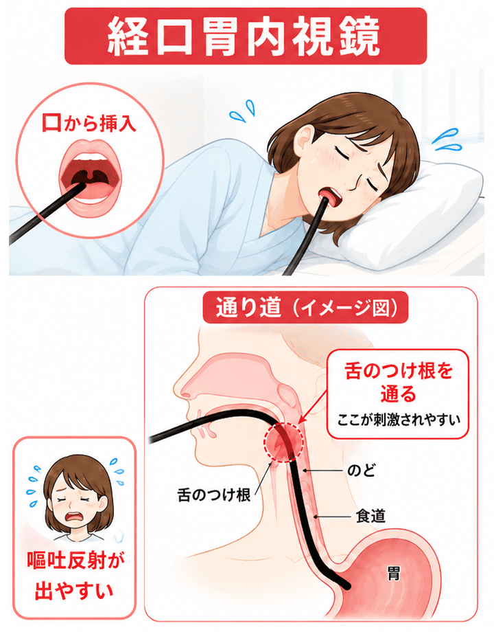 経口内視鏡